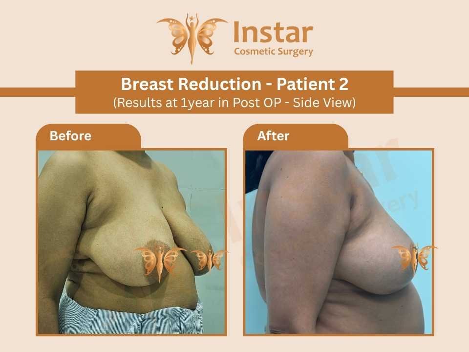 Breast Reduction ((Results at 1year in Post OP - Side View)